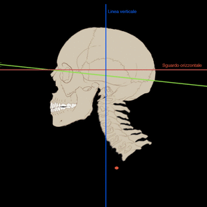 Animated diagram showing how loss of dental height tilts the skull off the vertical axis, producing forward head posture relative to the horizontal gaze line.