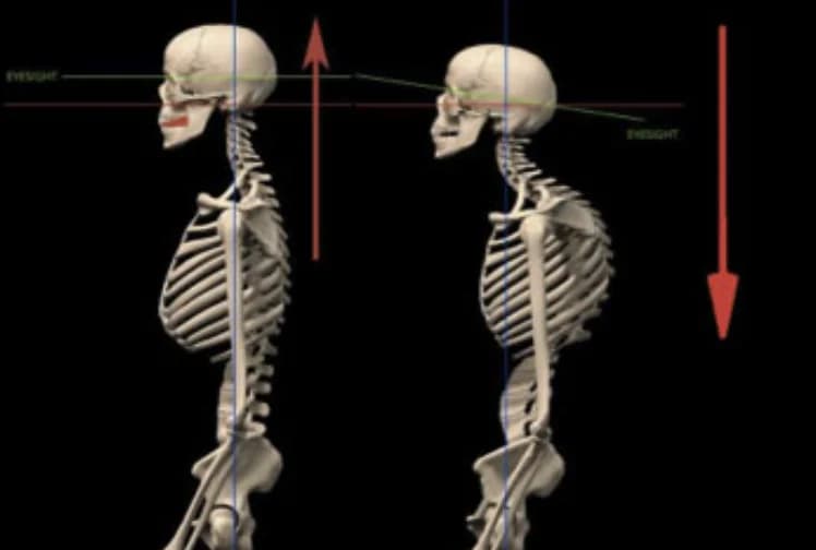 Side-by-side skeletons showing the postural cascade: an upright skeleton with level eyesight and arrow-up versus a collapsed skeleton with forward head posture, dropped eyesight line, and arrow-down — the same cranial-spinal distortion driving facial asymmetry.