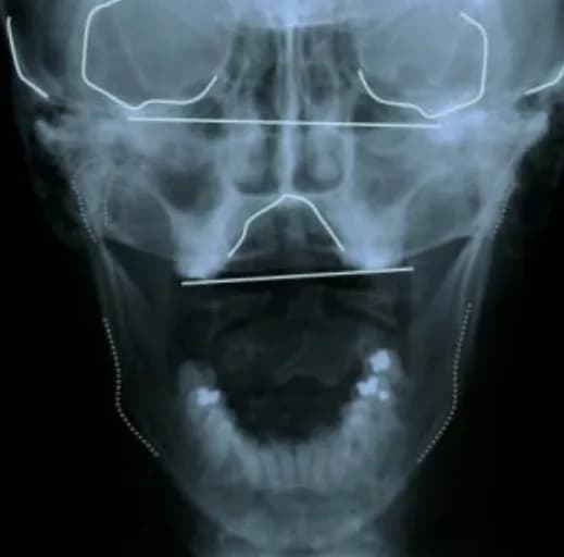 X-ray of a side-bending rotation, with one side of the skull longer and its cheekbone flared outward