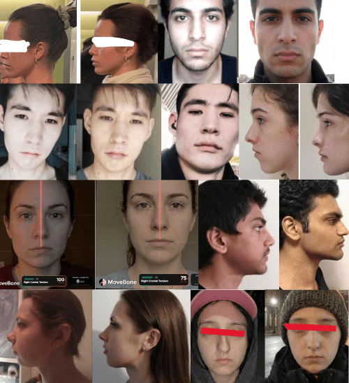 Before-and-after photos of several people whose facial asymmetry and midface position visibly shifted, two with MoveBone scan readings dropping from higher to lower cranial tension