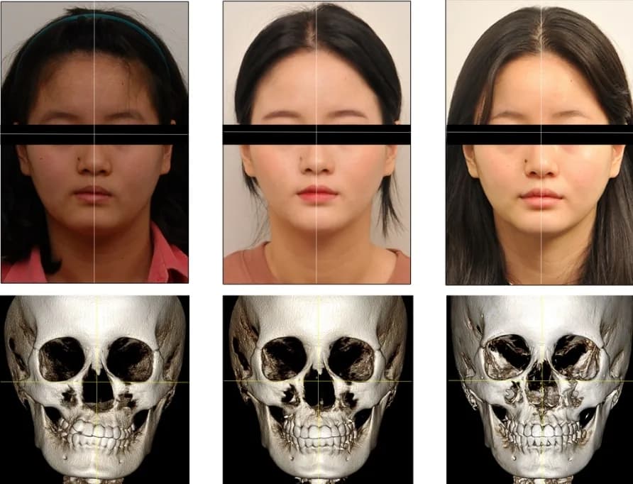 A skull tilting and settling out of balance in stages as dental height drops and the cranial bones shift