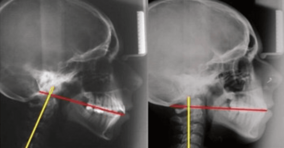 Side-by-side lateral cephalometric radiographs of an adult skull and cervical spine, marked with red and yellow reference lines showing forward head posture on the left and a corrected atlas-to-cranial-base alignment on the right