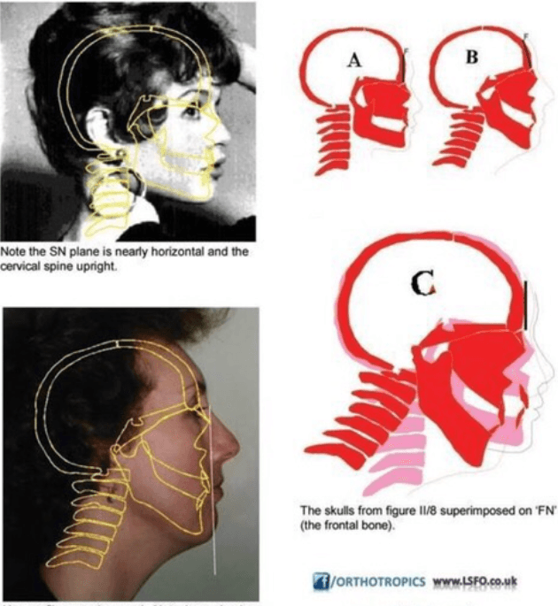 Orthotropics overlay diagram showing how head and cervical posture pull the entire facial skeleton into a downward, recessed configuration — the cascade from atlas position to facial bone position
