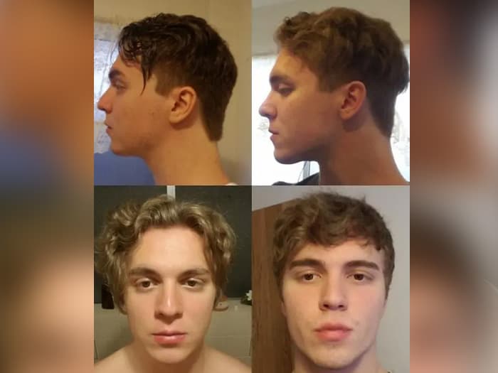Side profile of a man before and after cranial repositioning, showing dramatic jawline and midface change in adulthood