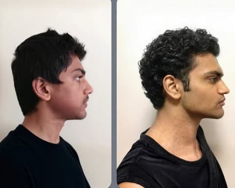 Side profile before and after of a young man whose face was repositioned through sustained loading — visible change in maxilla projection, chin position and jawline