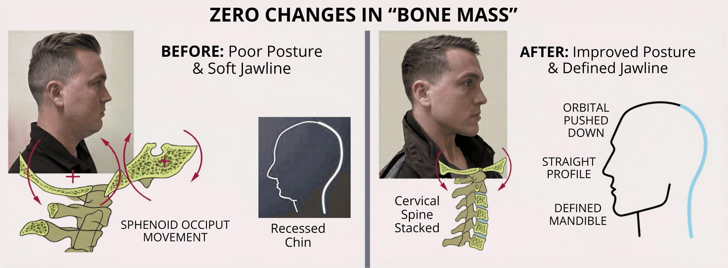 Before and after side-profile comparison labeled 'Zero changes in bone mass' — the same man with poor posture and a soft jawline versus improved posture, a defined mandible and a straighter profile, with anatomical overlays of the sphenoid, occiput and cervical spine showing how repositioning, not bone growth, drives the change