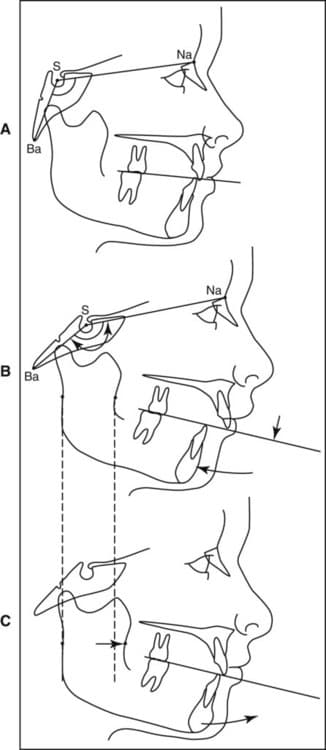 Cephalometric diagrams labeled A, B, C showing the mandible rotating into different positions relative to the cranial base as the maxilla and condyles shift