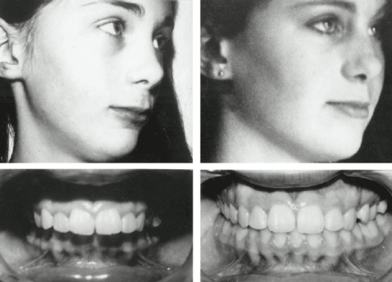 Before and after photos of a face and dental arch following orthodontic treatment, showing adult bone repositioning around the teeth and a visible change in midface shape
