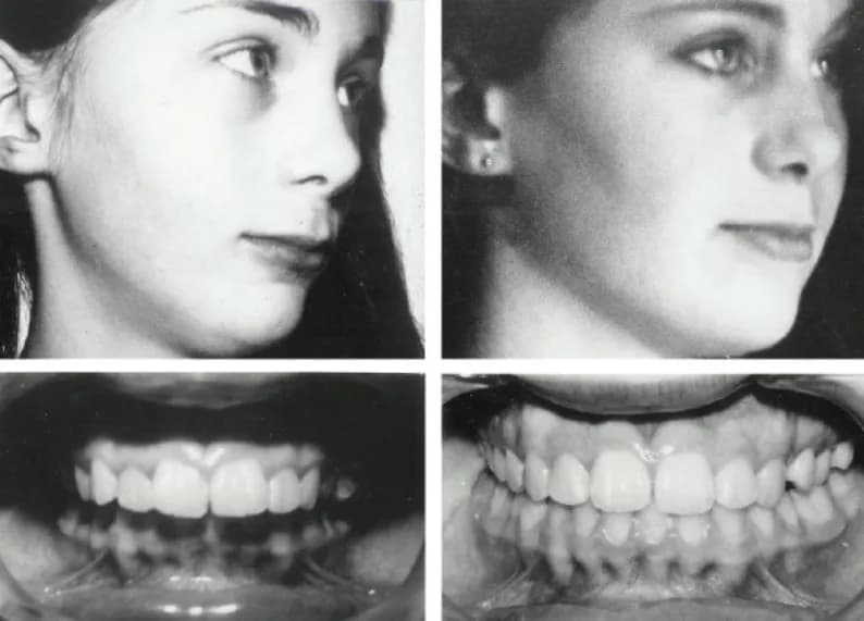 Before and after of the upper jaw guided forward and up, restoring support to the midface