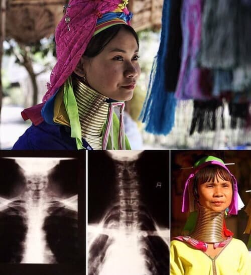 Kayan tribe woman wearing brass neck rings, with radiographs showing how the clavicles and cervical vertebrae have been permanently repositioned by sustained directional load in adulthood