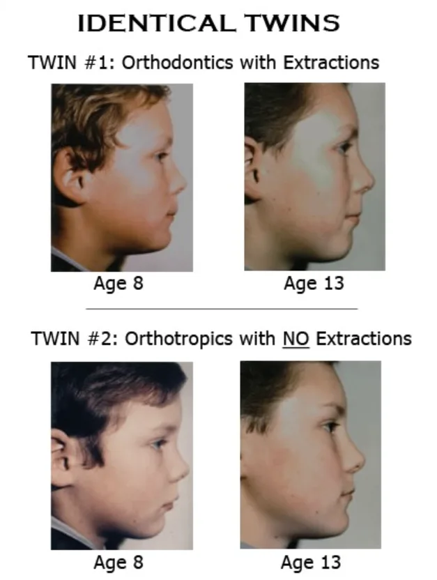 Identical twins at age 8 and 13 — Twin 1 had orthodontics with extractions, Twin 2 had orthotropics with no extractions. Twin 1's face retracted noticeably by age 13.