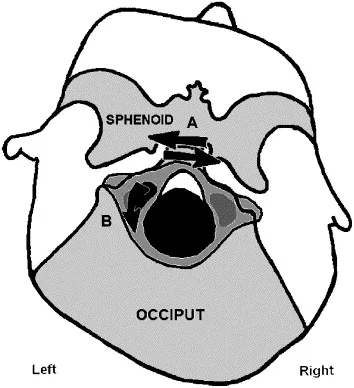 Diagram of a cranial strain pattern — the specific shape a collapse takes