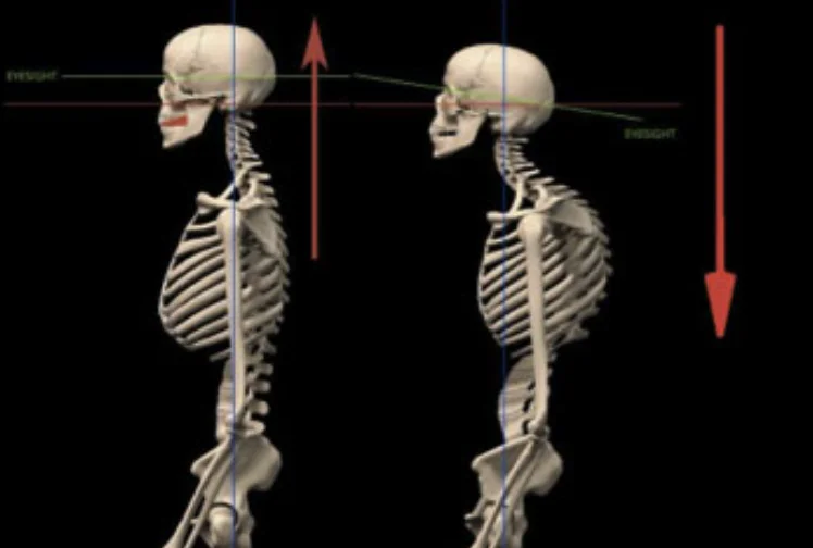 Skeleton showing how a forward-head posture cascades down the spine