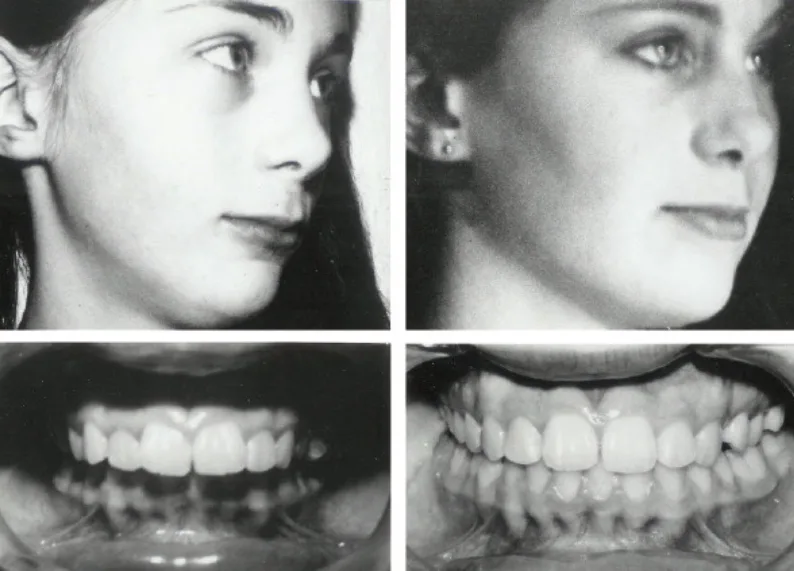 Before-and-after diagram of a biobloc appliance changing the face and moving the bones and expanding the palate